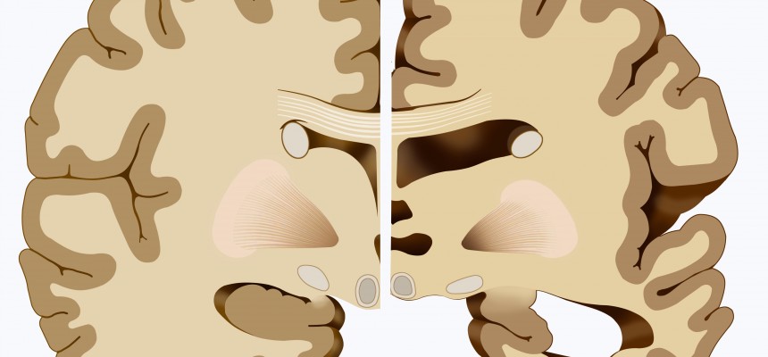 Alzheimer : la régulation du peptide Aβ dans le cerveau malade Alzheimer : la régulation du peptide Aβ dans le cerveau malade