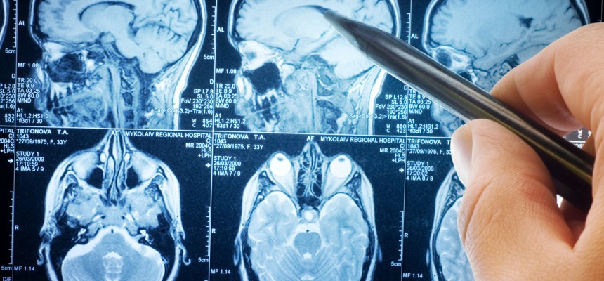 Le cholestérol et la maladie d’Alzheimer Le cholestérol et la maladie d’Alzheimer